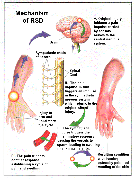 Reflex Sympathetic Dystrophy Syndrome.